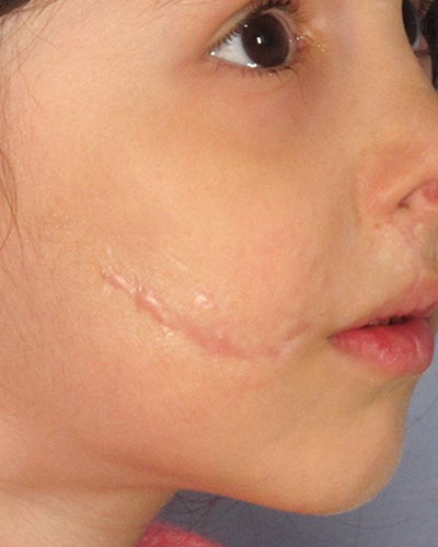 ترمیم اسکارهای صورت