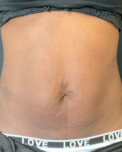 جوانسازی شکم