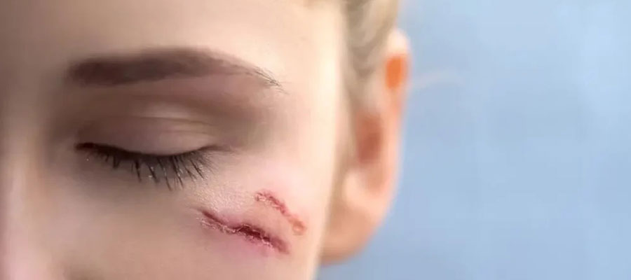 زخم اسکار [از بین بردن جای زخم]